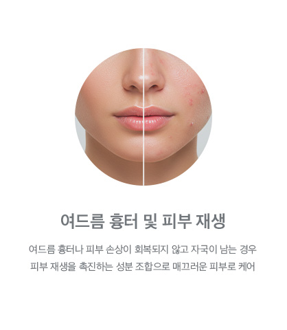 여드름 흉터 및 피부 재생
